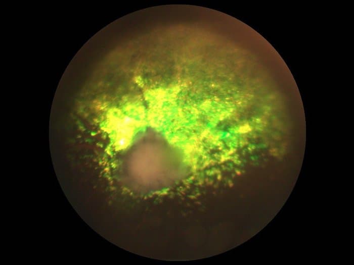 choroidal dysplasia