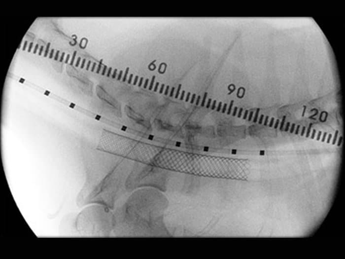 correct collapsing trachea