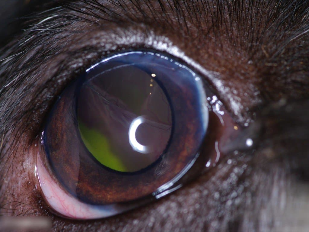 retinal detachment